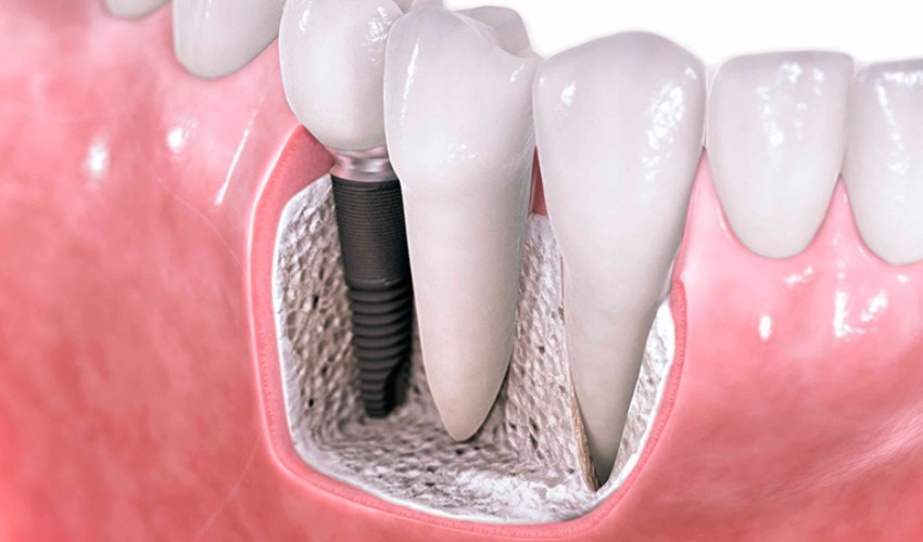Виды зубных имплантов. Имплант какой фирмы лучше? | Стоматологическая  клиника Ликорис | Стоматолог Винница Лікорис
